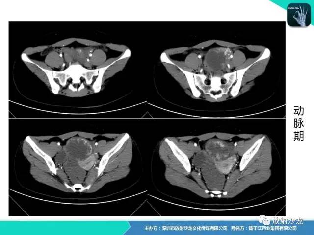 【病例】卵巢硬化性间质瘤1例CT