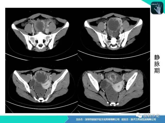 【病例】卵巢硬化性间质瘤1例CT