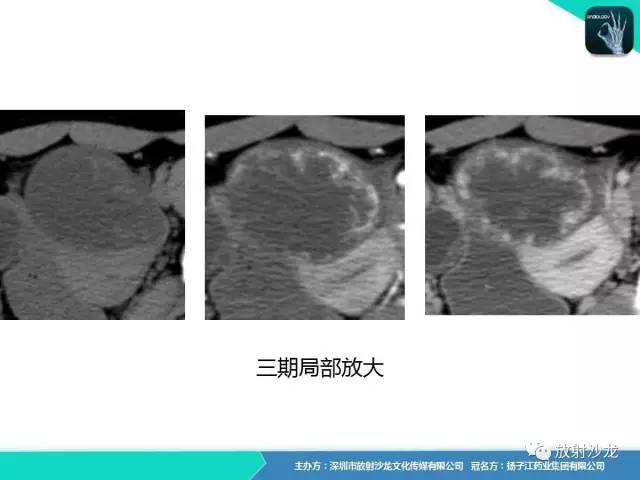 【病例】卵巢硬化性间质瘤1例CT