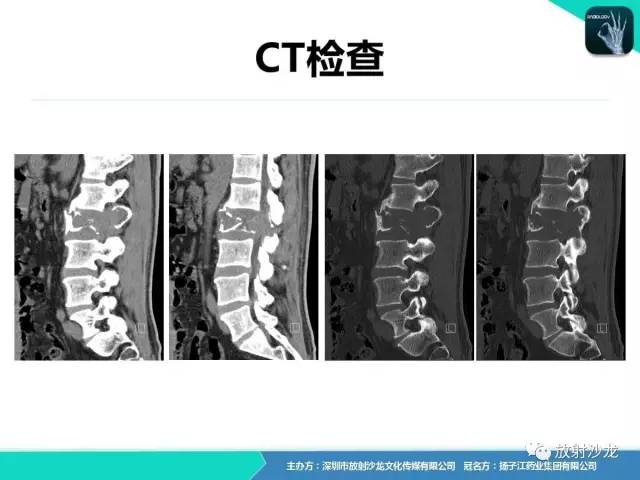 【病例】腰椎孤立性浆细胞性骨髓瘤1例CT及MR