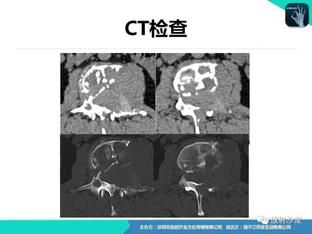 【病例】腰椎孤立性浆细胞性骨髓瘤1例CT及MR