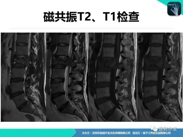 【病例】腰椎孤立性浆细胞性骨髓瘤1例CT及MR