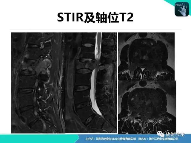 【病例】腰椎孤立性浆细胞性骨髓瘤1例CT及MR