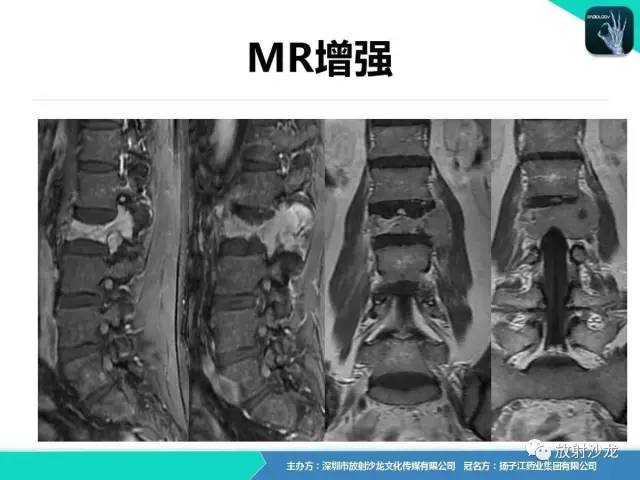 【病例】腰椎孤立性浆细胞性骨髓瘤1例CT及MR