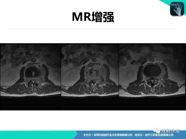 【病例】腰椎孤立性浆细胞性骨髓瘤1例CT及MR
