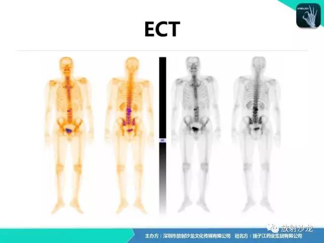 【病例】腰椎孤立性浆细胞性骨髓瘤1例CT及MR