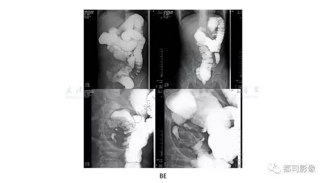 【病例】先天性肠旋转不良伴扭转1例X线CT