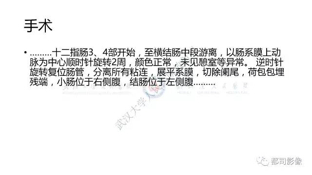 【病例】先天性肠旋转不良伴扭转1例X线CT