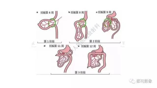 【病例】先天性肠旋转不良伴扭转1例X线CT