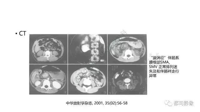 【病例】先天性肠旋转不良伴扭转1例X线CT