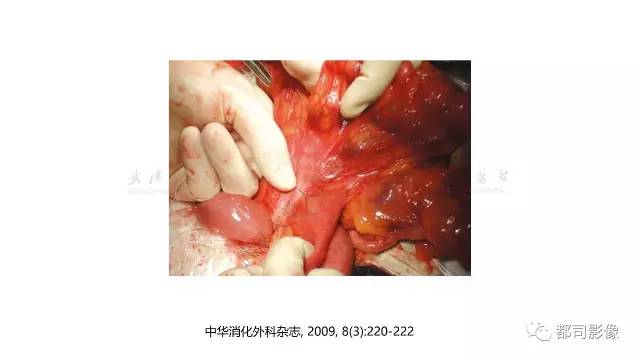 【病例】先天性肠旋转不良伴扭转1例X线CT