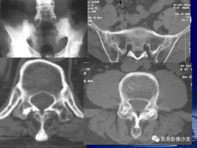 【PPT】强直性脊柱炎的影像学诊断