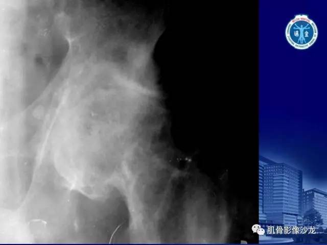 【PPT】强直性脊柱炎的影像学诊断