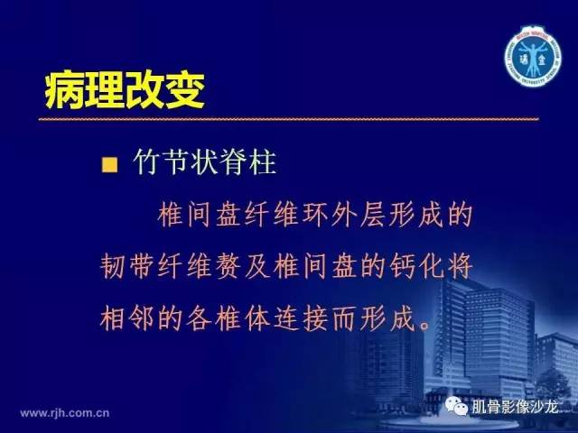 【PPT】强直性脊柱炎的影像学诊断