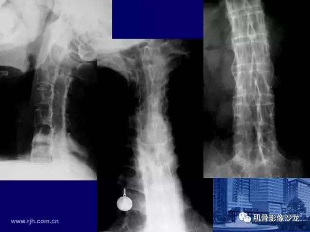 【PPT】强直性脊柱炎的影像学诊断