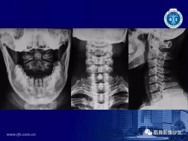 【PPT】强直性脊柱炎的影像学诊断