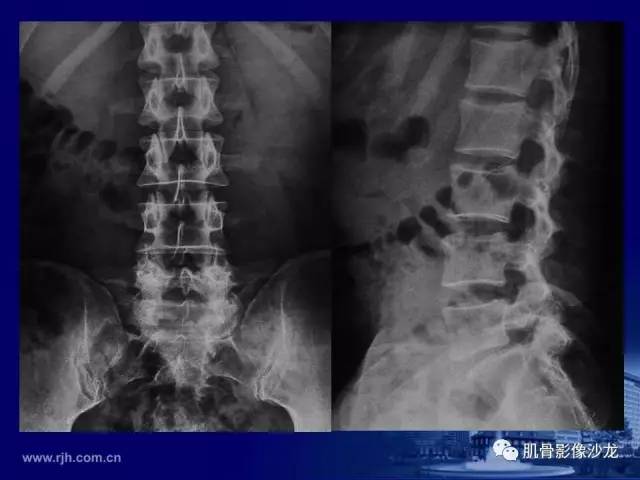【PPT】强直性脊柱炎的影像学诊断