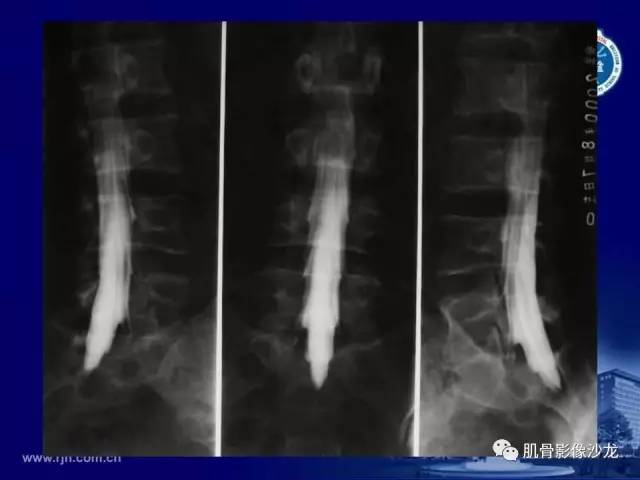 【PPT】强直性脊柱炎的影像学诊断