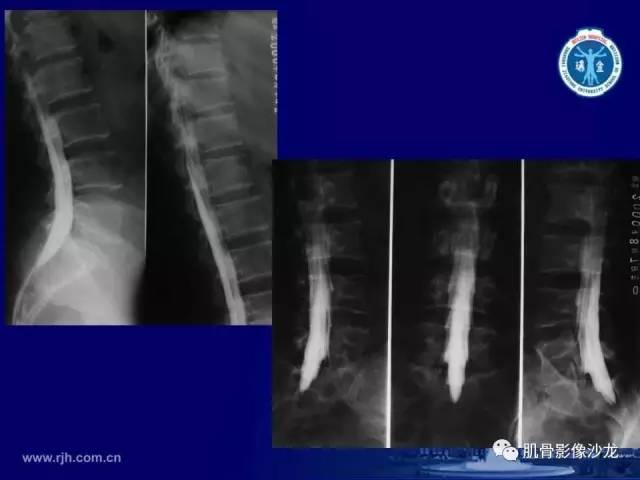 【PPT】强直性脊柱炎的影像学诊断