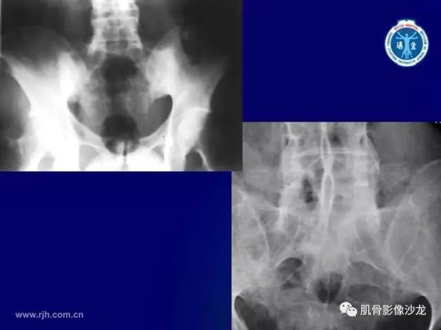 【PPT】强直性脊柱炎的影像学诊断