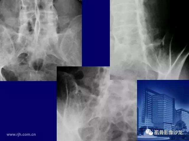 【PPT】强直性脊柱炎的影像学诊断