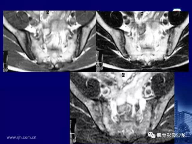 【PPT】强直性脊柱炎的影像学诊断