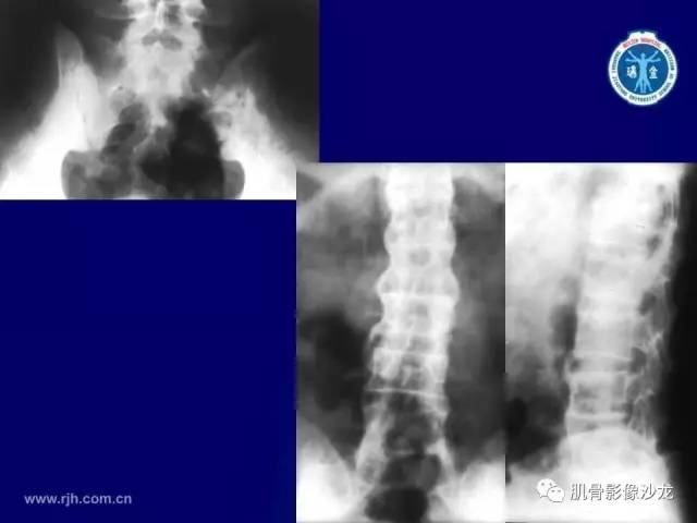 【PPT】强直性脊柱炎的影像学诊断