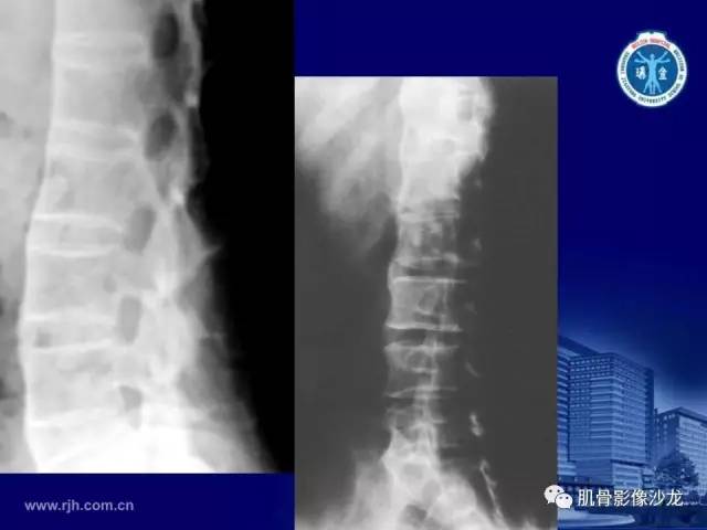 【PPT】强直性脊柱炎的影像学诊断