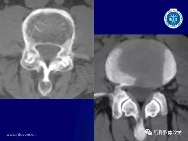 【PPT】强直性脊柱炎的影像学诊断
