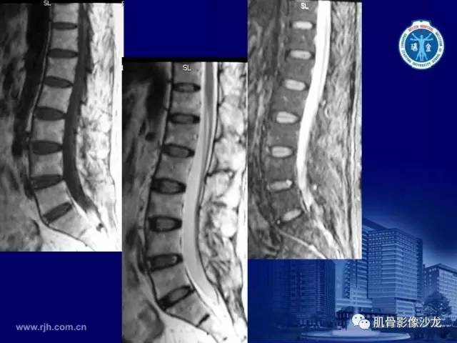 【PPT】强直性脊柱炎的影像学诊断