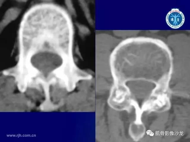 【PPT】强直性脊柱炎的影像学诊断