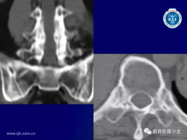 【PPT】强直性脊柱炎的影像学诊断
