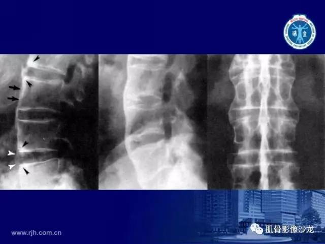 【PPT】强直性脊柱炎的影像学诊断