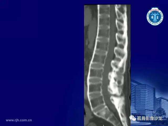 【PPT】强直性脊柱炎的影像学诊断