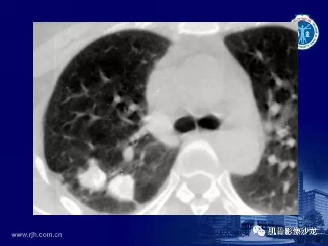 【PPT】强直性脊柱炎的影像学诊断