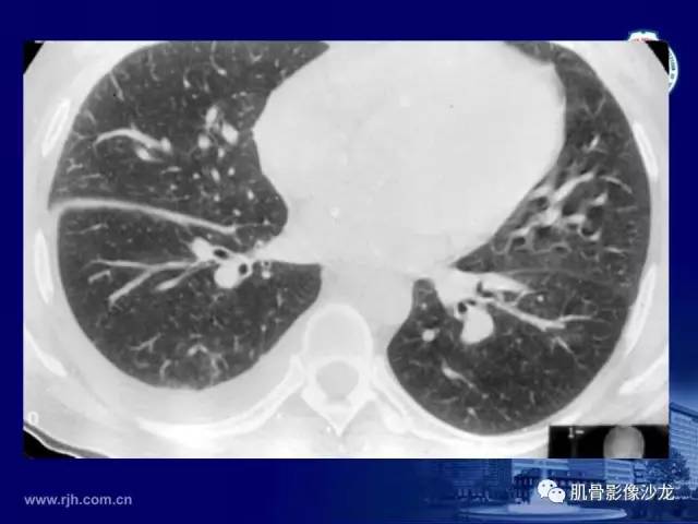 【PPT】强直性脊柱炎的影像学诊断