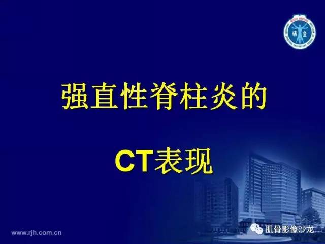 【PPT】强直性脊柱炎的影像学诊断