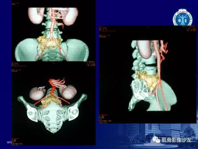 【PPT】强直性脊柱炎的影像学诊断