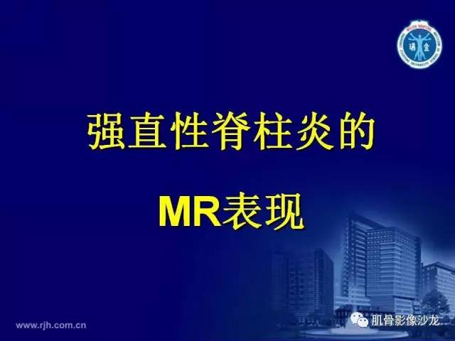 【PPT】强直性脊柱炎的影像学诊断