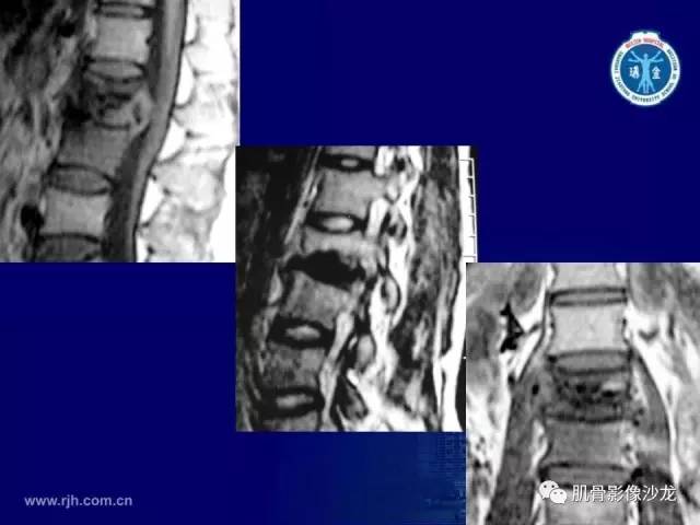 【PPT】强直性脊柱炎的影像学诊断