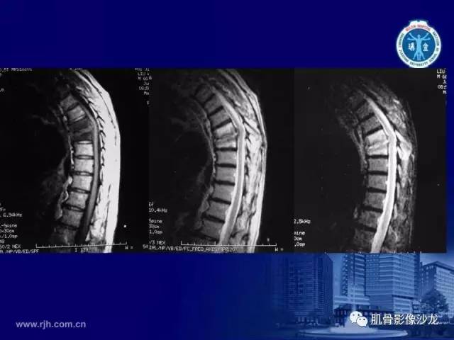 【PPT】强直性脊柱炎的影像学诊断