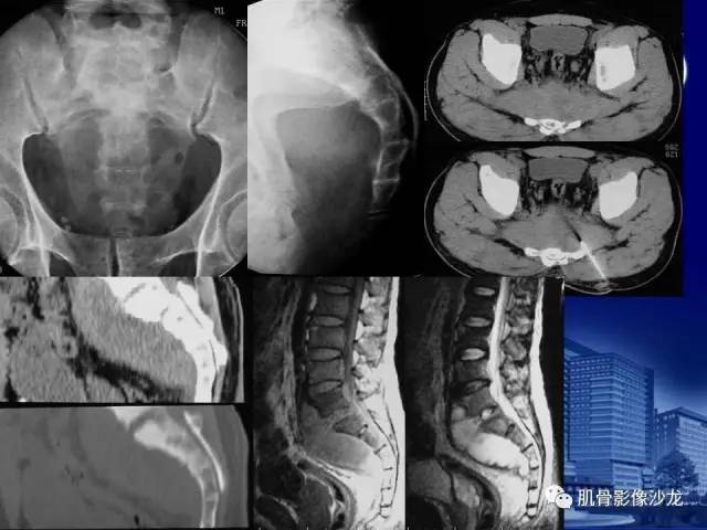 【PPT】强直性脊柱炎的影像学诊断