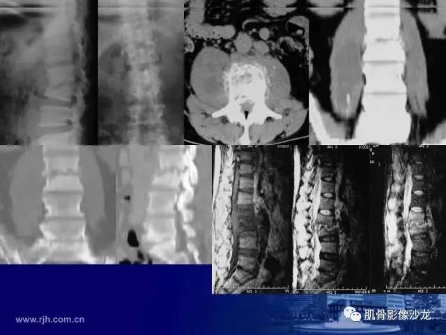 【PPT】强直性脊柱炎的影像学诊断