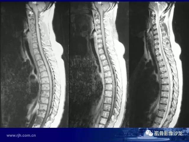 【PPT】强直性脊柱炎的影像学诊断