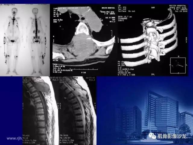 【PPT】强直性脊柱炎的影像学诊断