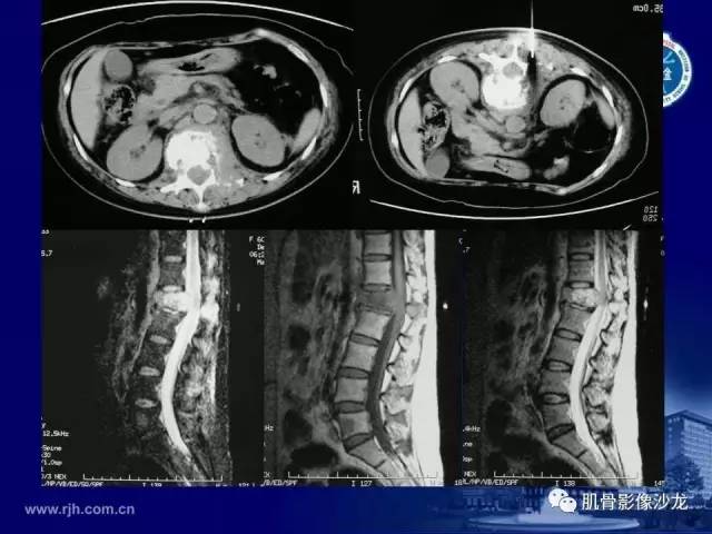 【PPT】强直性脊柱炎的影像学诊断
