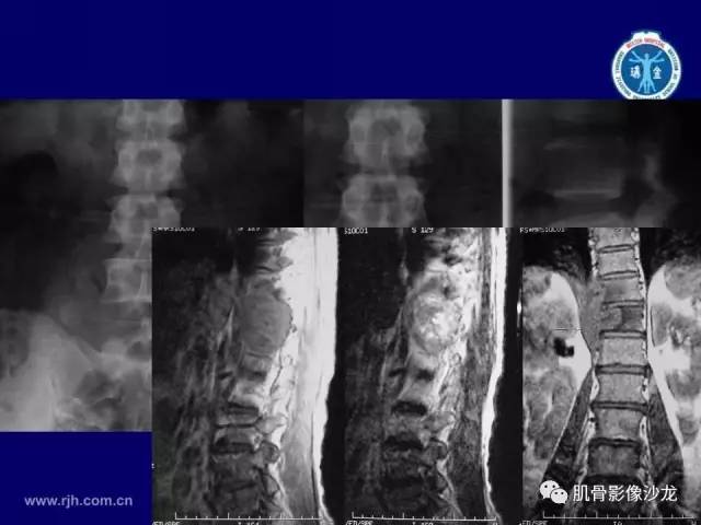 【PPT】强直性脊柱炎的影像学诊断