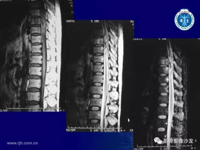 【PPT】强直性脊柱炎的影像学诊断