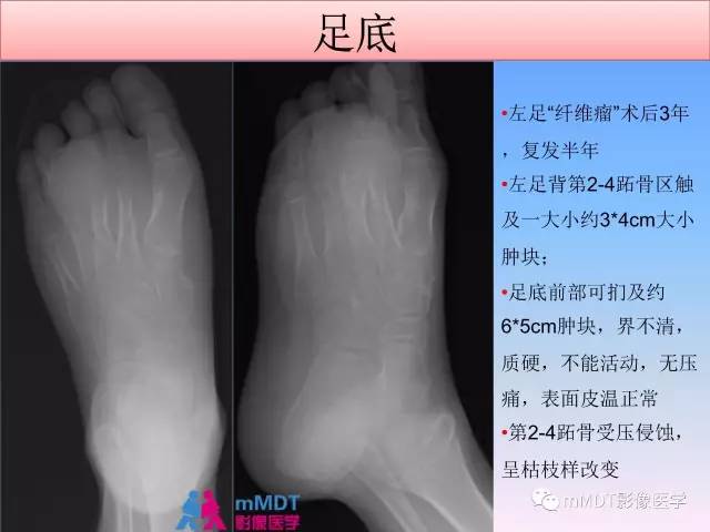 【PPT】韧带样纤维瘤病的影像分析