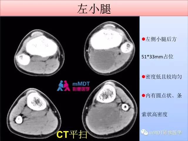【PPT】韧带样纤维瘤病的影像分析